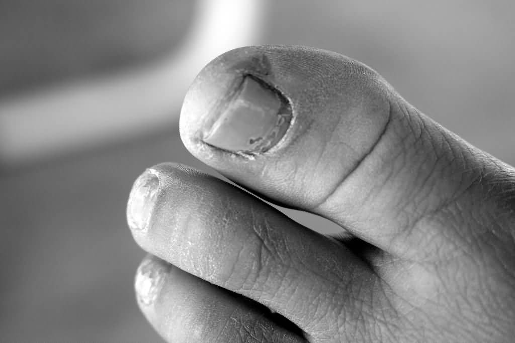 Грибок ногтя на большом пальце ноги — причины и методы лечения