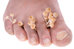 грибок между пальцами ног