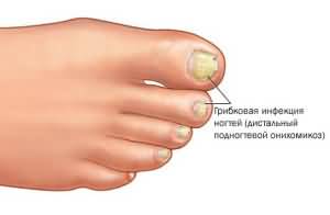 Грибковая инфекция ногтей
