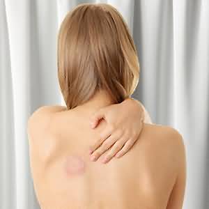 Грибок кожи на теле — разновидности и способы лечения