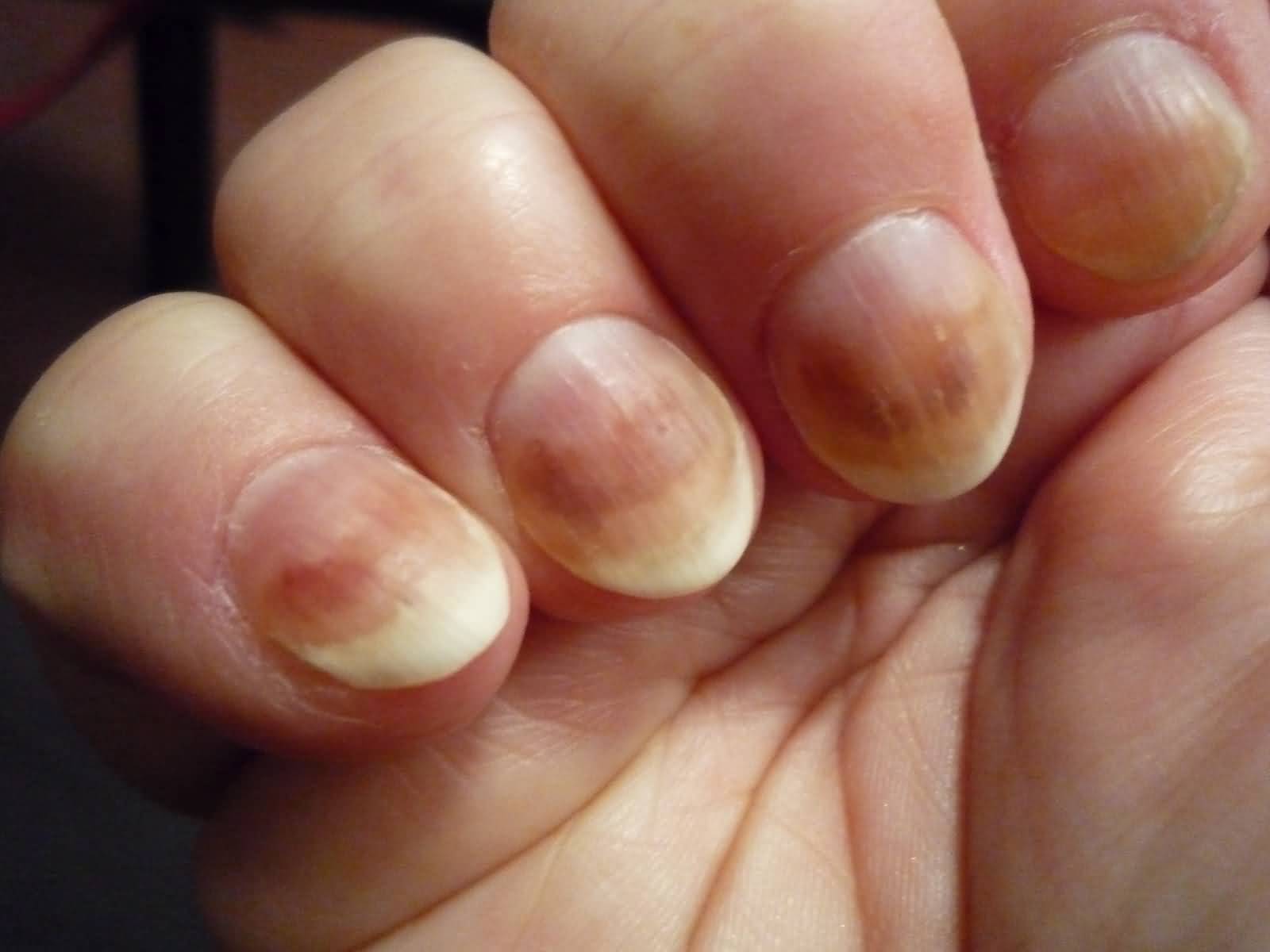 Грибок ногтей на руках — как выглядит и чем лечить?